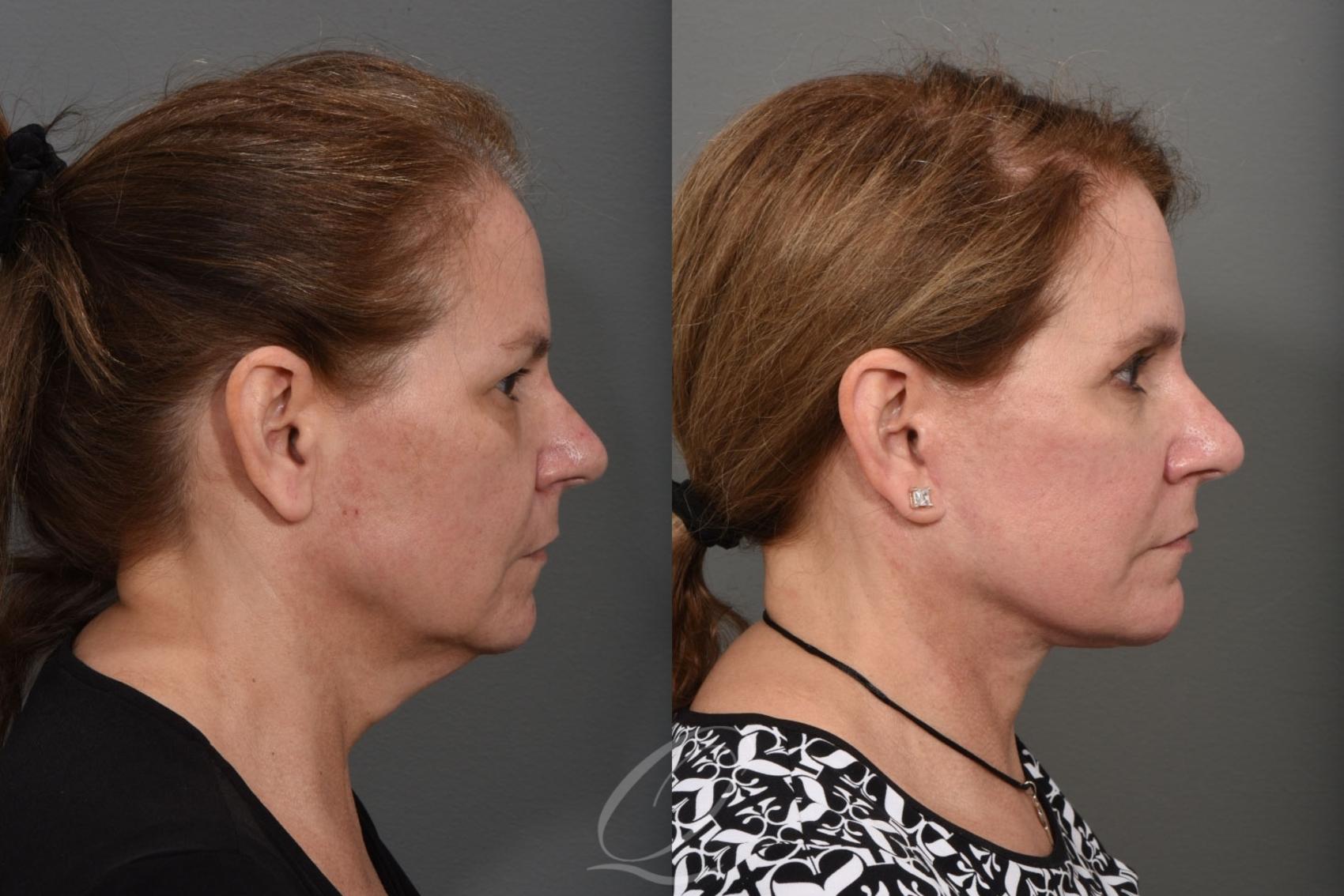Facelift Case 1469 Before & After Right Side | Serving Rochester, Syracuse & Buffalo, NY | Quatela Center for Plastic Surgery
