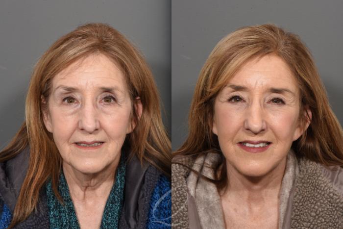 Facelift Case 1470 Before & After Front | Serving Rochester, Syracuse & Buffalo, NY | Quatela Center for Plastic Surgery