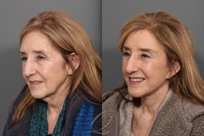 Facelift Case 1470 Before & After Left Oblique | Serving Rochester, Syracuse & Buffalo, NY | Quatela Center for Plastic Surgery