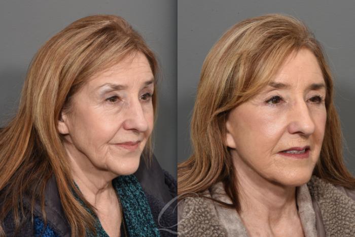 Eyelid Lift Case 1470 Before & After Right Oblique | Serving Rochester, Syracuse & Buffalo, NY | Quatela Center for Plastic Surgery