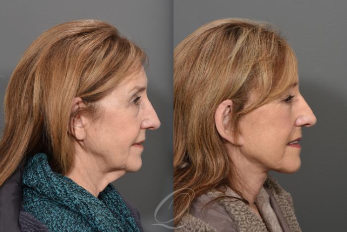 Facelift Case 1470 Before & After Right Side | Serving Rochester, Syracuse & Buffalo, NY | Quatela Center for Plastic Surgery
