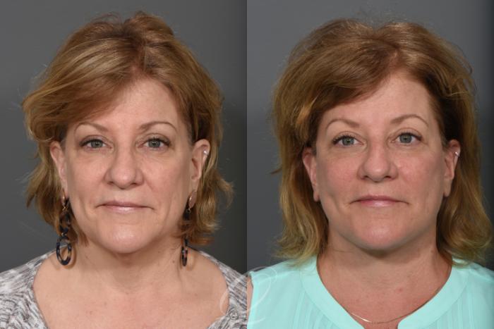 Facelift Case 1491 Before & After Front | Serving Rochester, Syracuse & Buffalo, NY | Quatela Center for Plastic Surgery