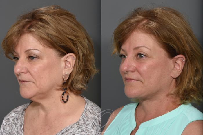 Facelift Case 1491 Before & After Left Oblique | Serving Rochester, Syracuse & Buffalo, NY | Quatela Center for Plastic Surgery