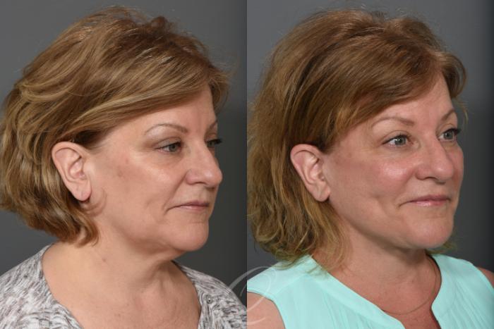 Facelift Case 1491 Before & After Right Oblique | Serving Rochester, Syracuse & Buffalo, NY | Quatela Center for Plastic Surgery