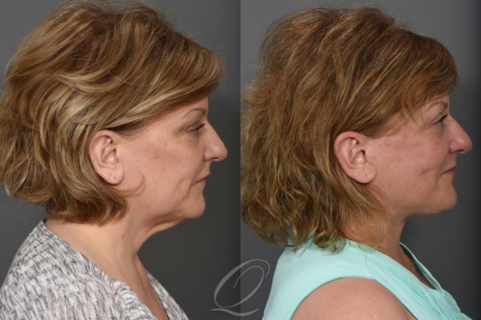 Facelift Case 1491 Before & After Right Side | Serving Rochester, Syracuse & Buffalo, NY | Quatela Center for Plastic Surgery
