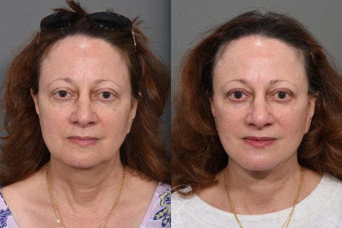 Facelift Case 1495 Before & After Front | Serving Rochester, Syracuse & Buffalo, NY | Quatela Center for Plastic Surgery