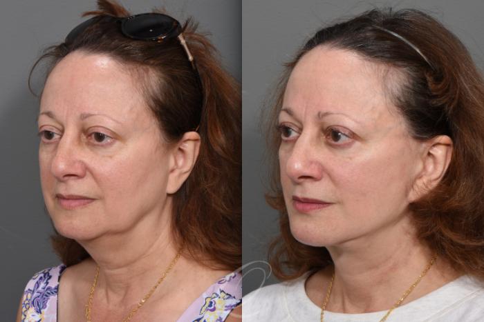 Facelift Case 1495 Before & After Left Oblique | Serving Rochester, Syracuse & Buffalo, NY | Quatela Center for Plastic Surgery