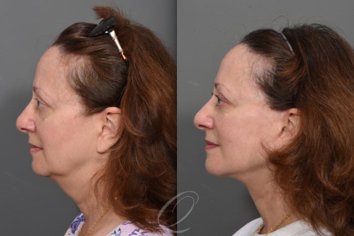 Facelift Case 1495 Before & After Left Side | Serving Rochester, Syracuse & Buffalo, NY | Quatela Center for Plastic Surgery