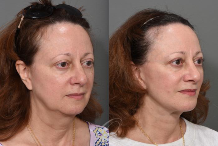 Facelift Case 1495 Before & After Right Oblique | Serving Rochester, Syracuse & Buffalo, NY | Quatela Center for Plastic Surgery