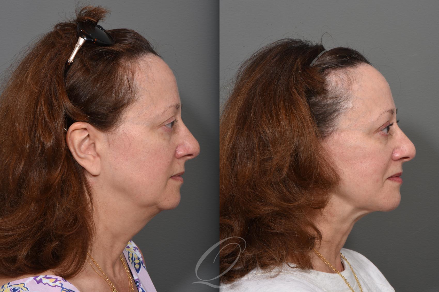 Facelift Case 1495 Before & After Right Side | Serving Rochester, Syracuse & Buffalo, NY | Quatela Center for Plastic Surgery