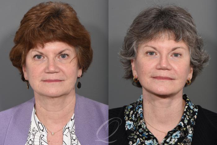 Brow Lift Case 1496 Before & After Front | Serving Rochester, Syracuse & Buffalo, NY | Quatela Center for Plastic Surgery