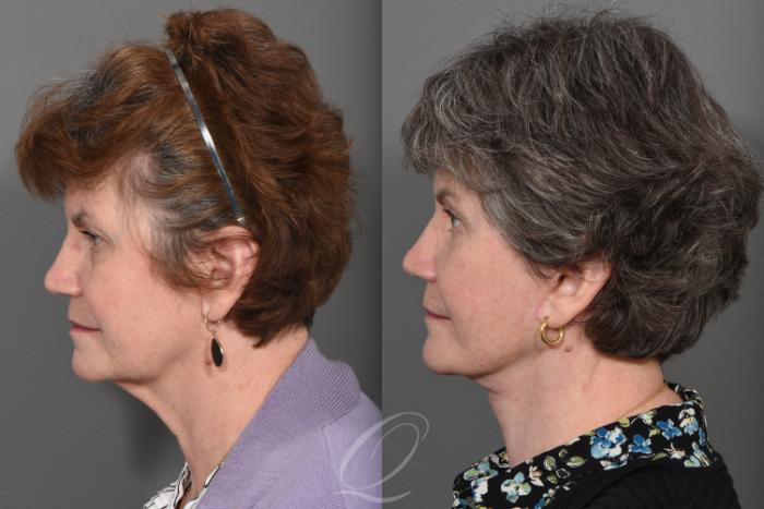 Brow Lift Case 1496 Before & After Left Side | Serving Rochester, Syracuse & Buffalo, NY | Quatela Center for Plastic Surgery