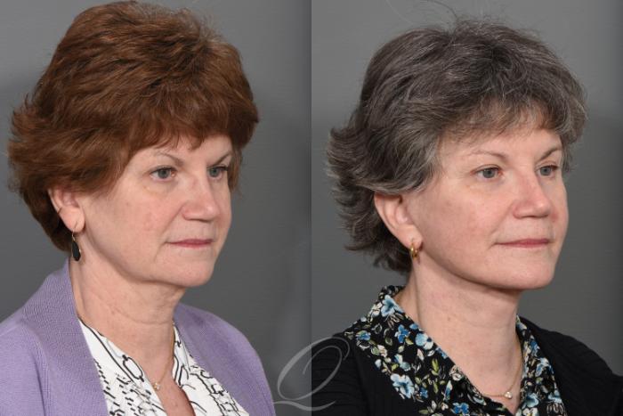 Brow Lift Case 1496 Before & After Right Oblique | Serving Rochester, Syracuse & Buffalo, NY | Quatela Center for Plastic Surgery