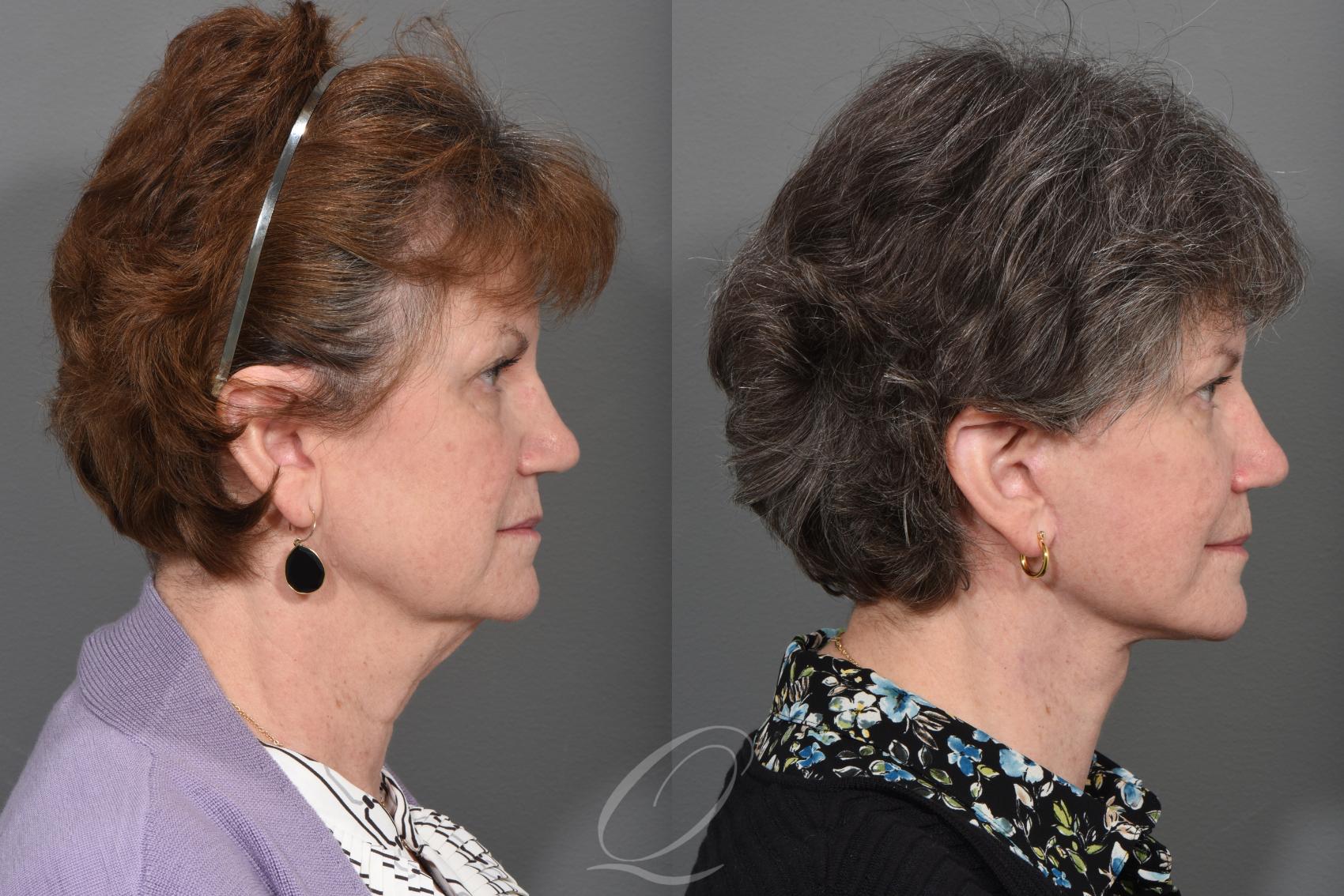 Facelift Case 1496 Before & After Right Side | Serving Rochester, Syracuse & Buffalo, NY | Quatela Center for Plastic Surgery