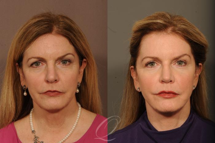 Rhinoplasty Case 1524 Before & After View #1 | Serving Rochester, Syracuse & Buffalo, NY | Quatela Center for Plastic Surgery