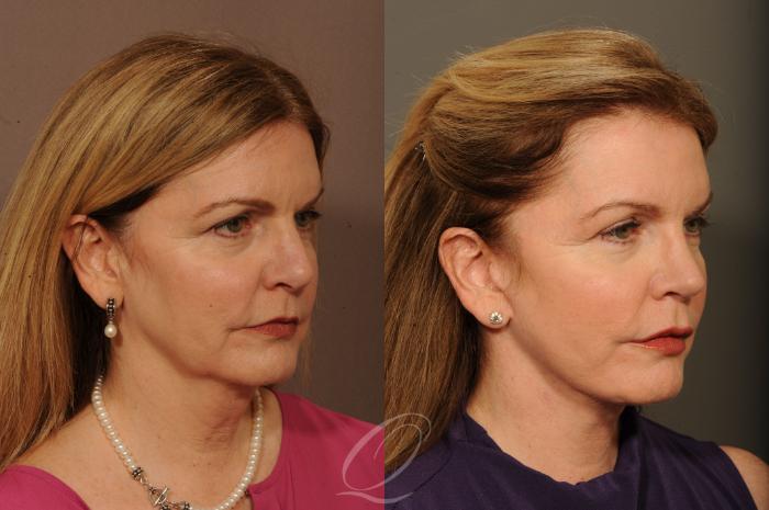 Facelift Case 1524 Before & After View #2 | Serving Rochester, Syracuse & Buffalo, NY | Quatela Center for Plastic Surgery