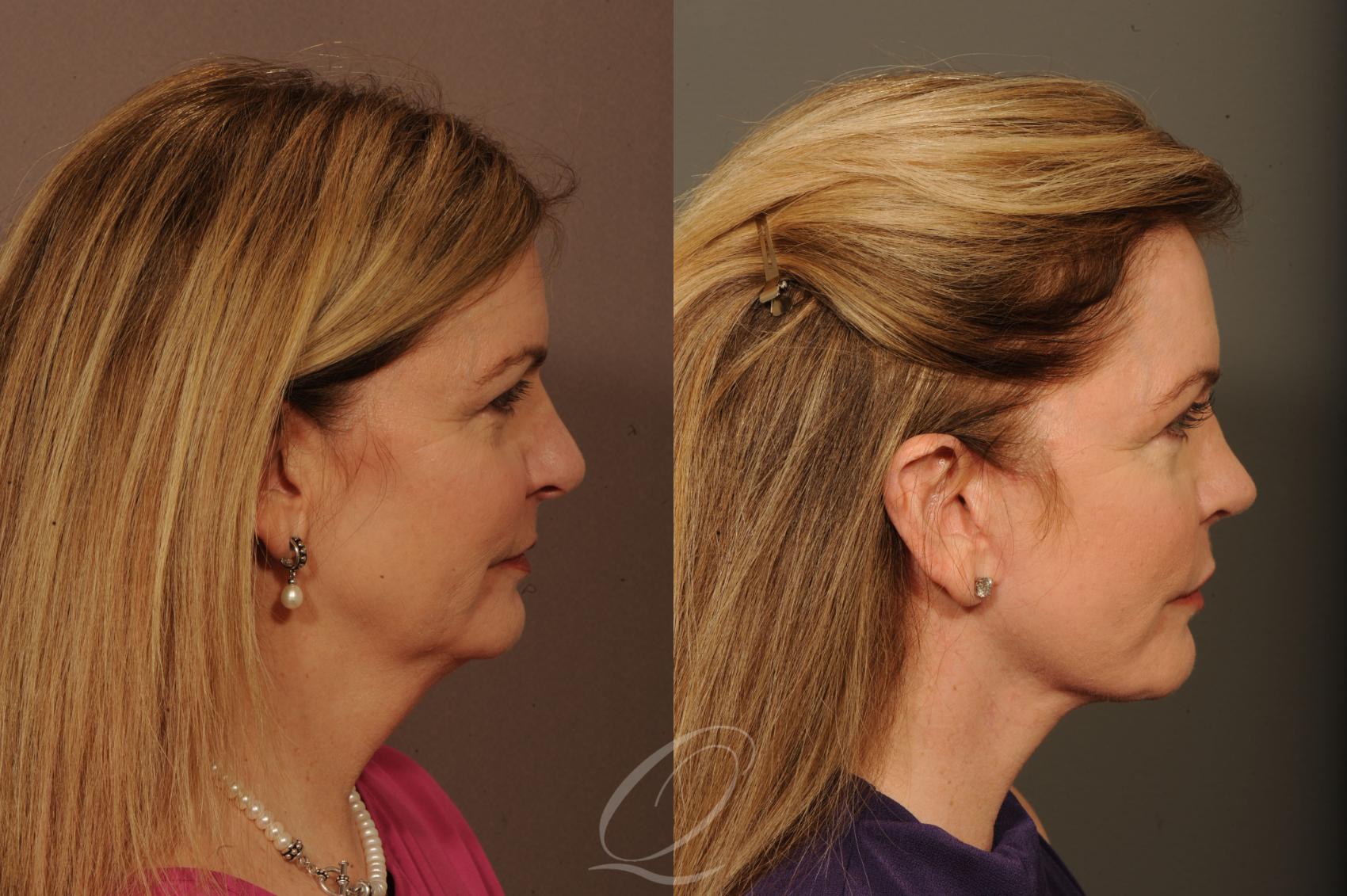 Rhinoplasty Case 1524 Before & After View #3 | Serving Rochester, Syracuse & Buffalo, NY | Quatela Center for Plastic Surgery