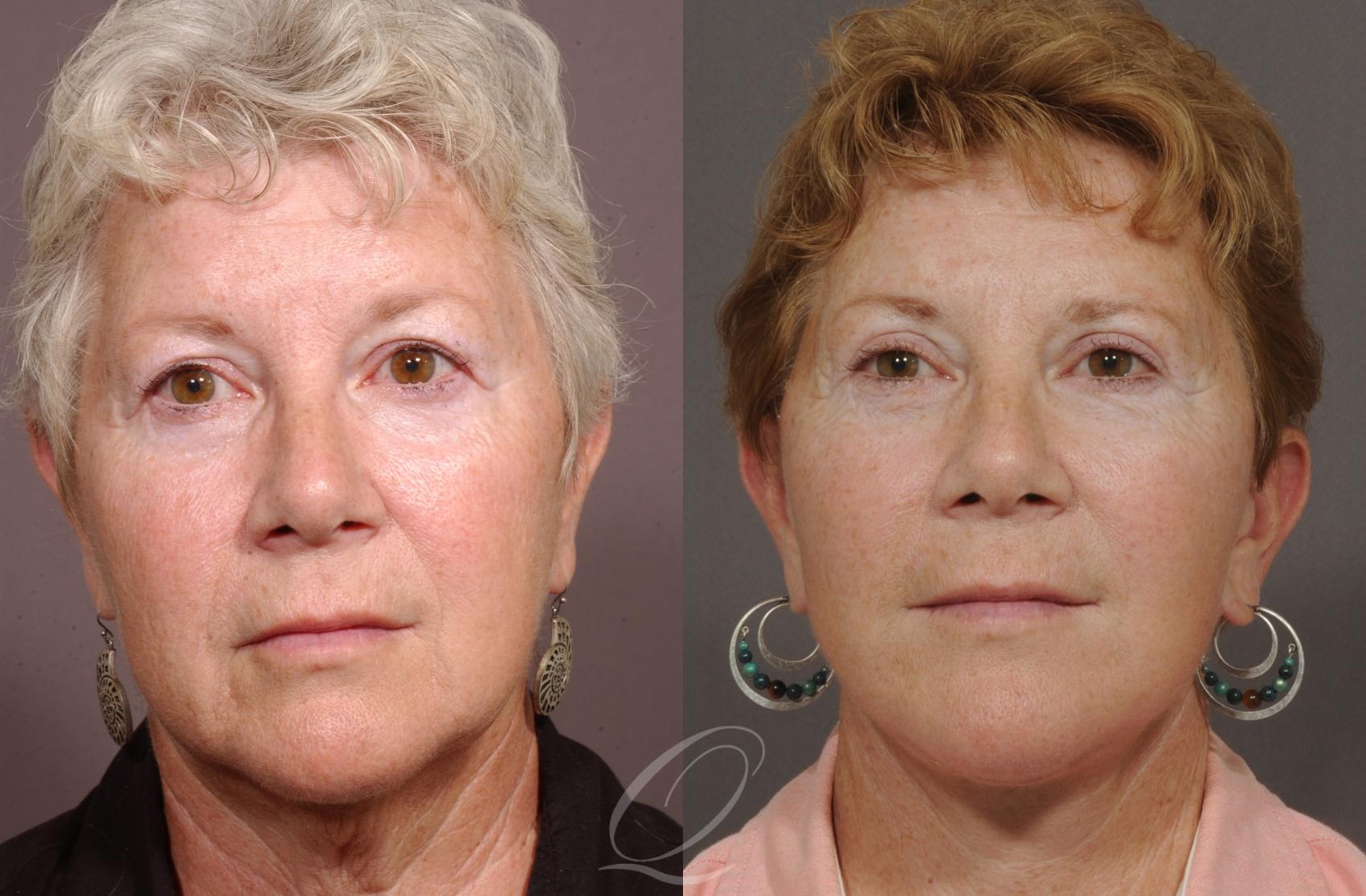 Facelift Case 17 Before & After View #1 | Serving Rochester, Syracuse & Buffalo, NY | Quatela Center for Plastic Surgery