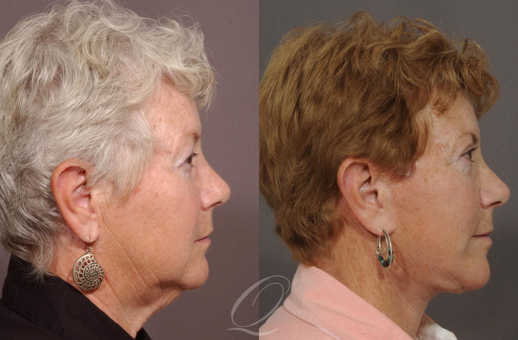 Facelift Case 17 Before & After View #3 | Serving Rochester, Syracuse & Buffalo, NY | Quatela Center for Plastic Surgery