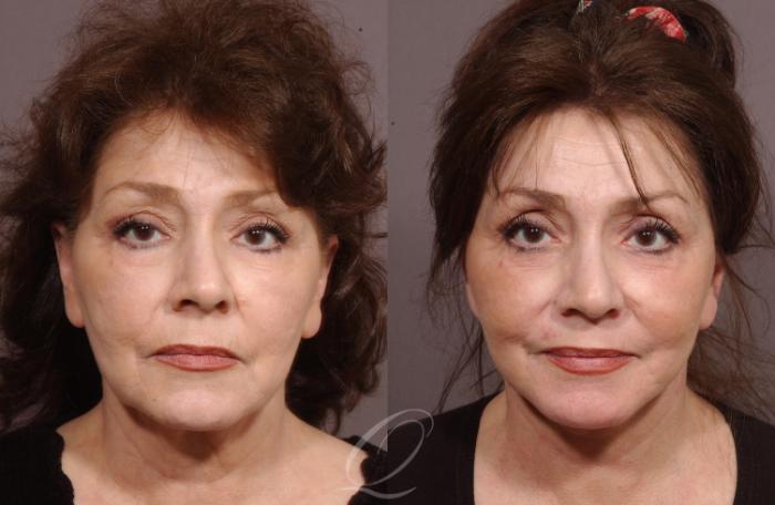 Facelift Case 19 Before & After View #1 | Serving Rochester, Syracuse & Buffalo, NY | Quatela Center for Plastic Surgery