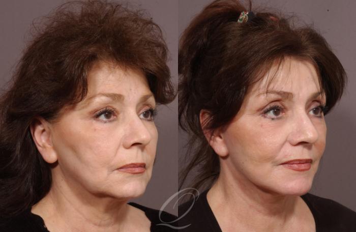 Facelift Case 19 Before & After View #2 | Serving Rochester, Syracuse & Buffalo, NY | Quatela Center for Plastic Surgery