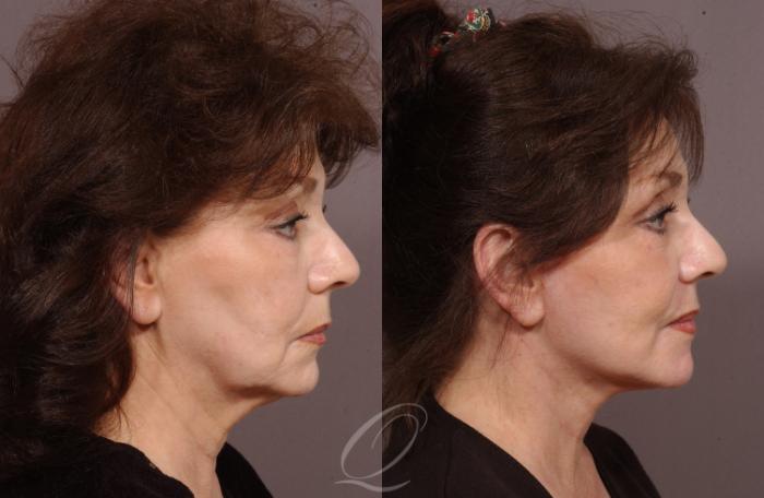 Facelift Case 19 Before & After View #3 | Serving Rochester, Syracuse & Buffalo, NY | Quatela Center for Plastic Surgery