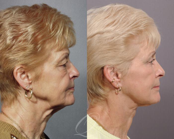 Facelift Case 20 Before & After View #2 | Serving Rochester, Syracuse & Buffalo, NY | Quatela Center for Plastic Surgery
