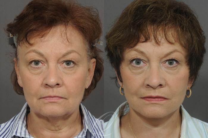 Facelift Case 21 Before & After View #1 | Serving Rochester, Syracuse & Buffalo, NY | Quatela Center for Plastic Surgery