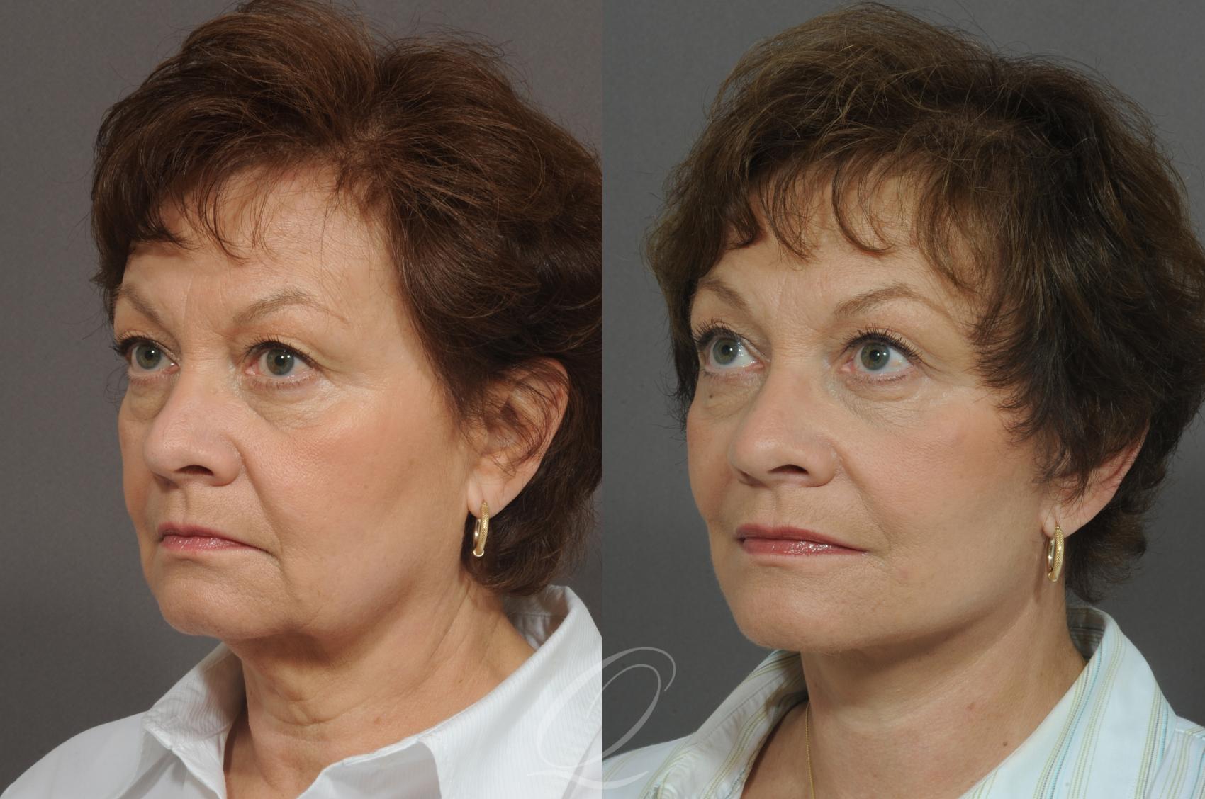 Facelift Case 21 Before & After View #2 | Serving Rochester, Syracuse & Buffalo, NY | Quatela Center for Plastic Surgery