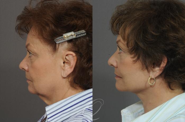 Facelift Case 21 Before & After View #3 | Serving Rochester, Syracuse & Buffalo, NY | Quatela Center for Plastic Surgery