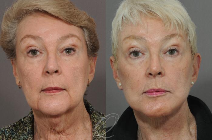 Facelift Case 25 Before & After View #1 | Serving Rochester, Syracuse & Buffalo, NY | Quatela Center for Plastic Surgery