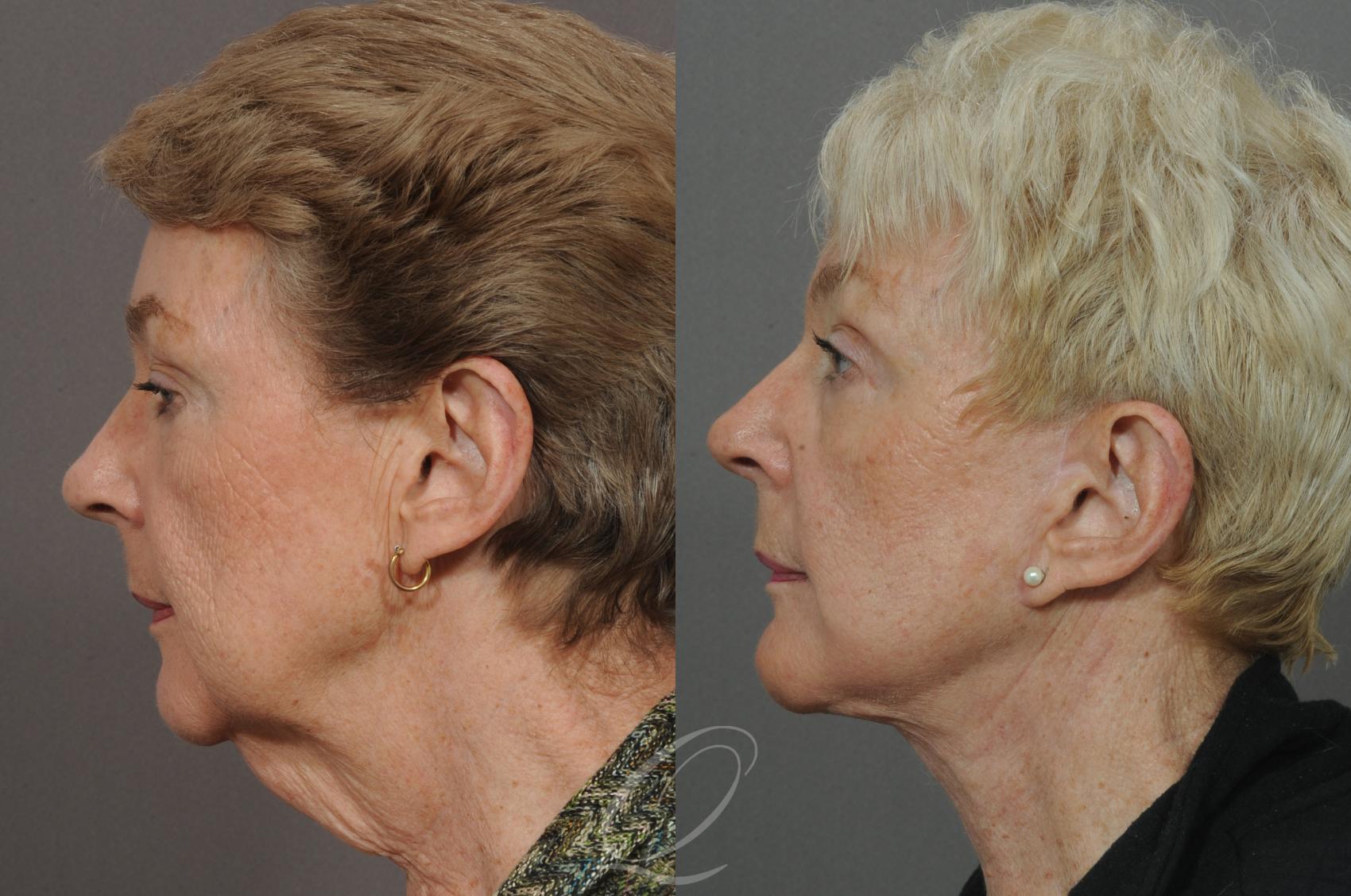 Facelift Case 25 Before & After View #2 | Serving Rochester, Syracuse & Buffalo, NY | Quatela Center for Plastic Surgery