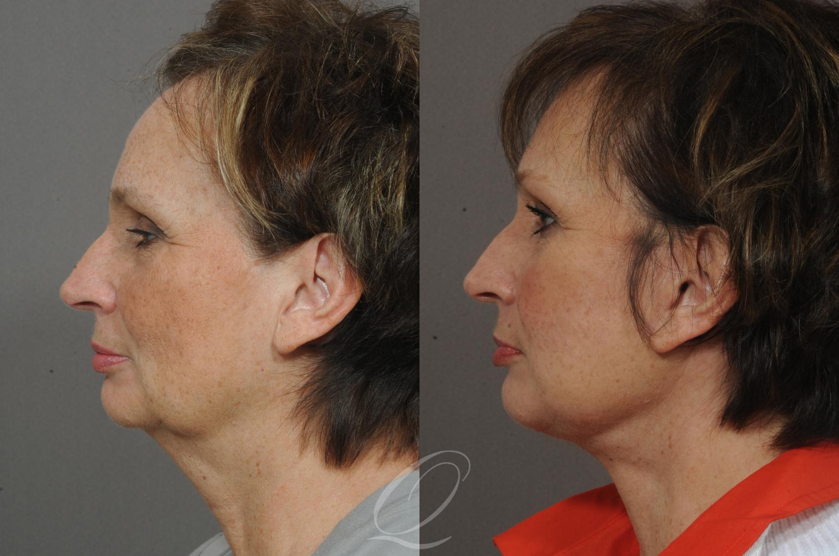 Facelift Case 26 Before & After View #3 | Serving Rochester, Syracuse & Buffalo, NY | Quatela Center for Plastic Surgery