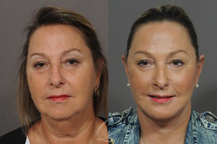 Facelift Case 27 Before & After View #1 | Serving Rochester, Syracuse & Buffalo, NY | Quatela Center for Plastic Surgery