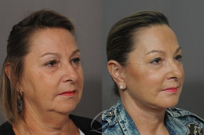 Facelift Case 27 Before & After View #2 | Serving Rochester, Syracuse & Buffalo, NY | Quatela Center for Plastic Surgery