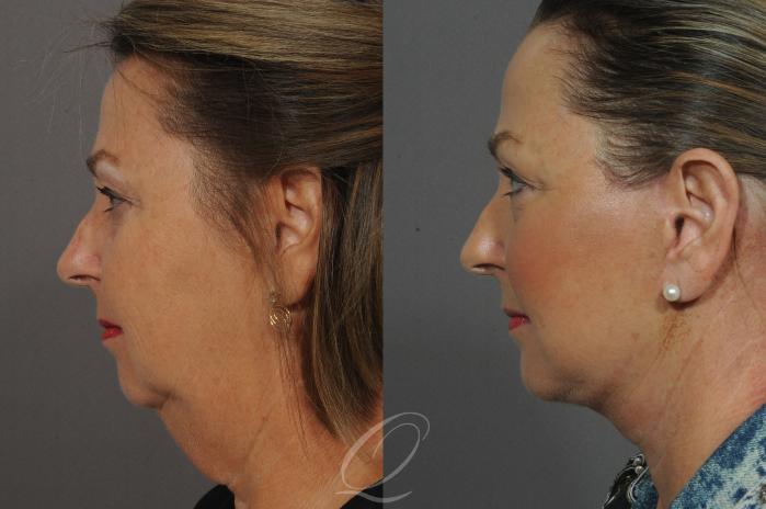 Facelift Case 27 Before & After View #3 | Serving Rochester, Syracuse & Buffalo, NY | Quatela Center for Plastic Surgery