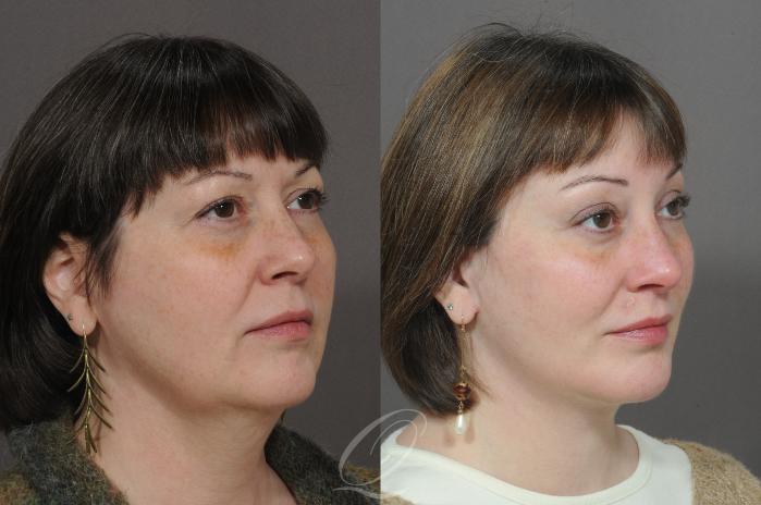 Facelift Case 294 Before & After View #2 | Serving Rochester, Syracuse & Buffalo, NY | Quatela Center for Plastic Surgery