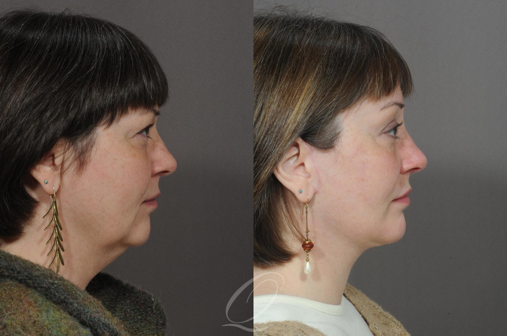 Chin Augmentation Case 294 Before & After View #3 | Serving Rochester, Syracuse & Buffalo, NY | Quatela Center for Plastic Surgery