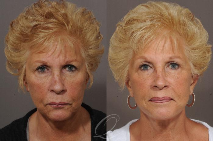 Facelift Case 305 Before & After View #4 | Serving Rochester, Syracuse & Buffalo, NY | Quatela Center for Plastic Surgery