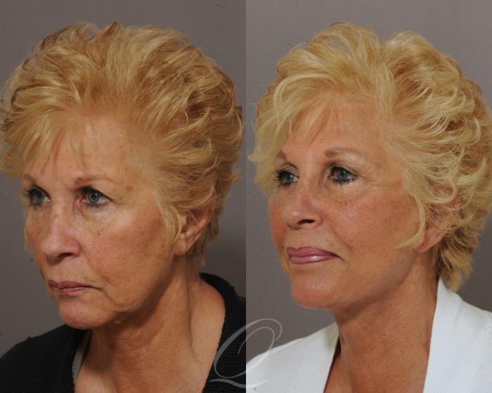 Eyelid Lift Case 305 Before & After View #5 | Serving Rochester, Syracuse & Buffalo, NY | Quatela Center for Plastic Surgery