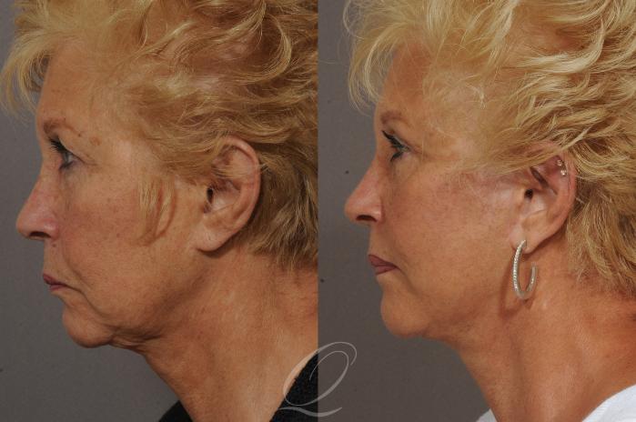 Facelift Case 305 Before & After View #6 | Serving Rochester, Syracuse & Buffalo, NY | Quatela Center for Plastic Surgery