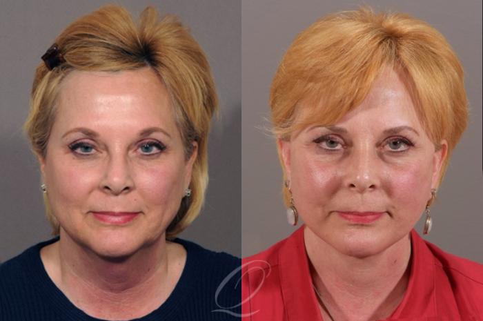 Facelift Case 311 Before & After View #1 | Serving Rochester, Syracuse & Buffalo, NY | Quatela Center for Plastic Surgery