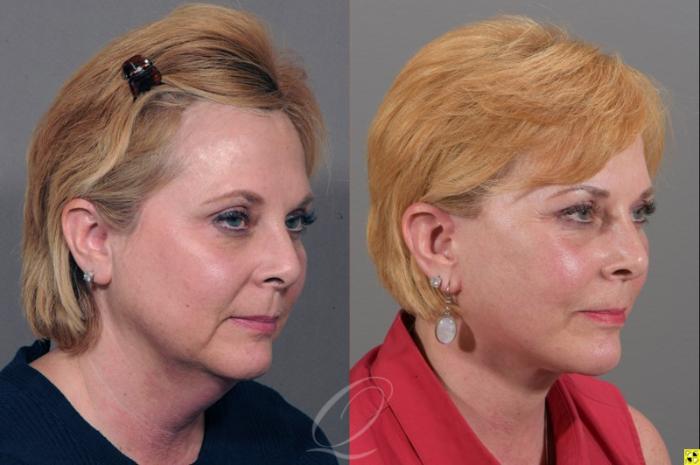 Facelift Case 311 Before & After View #2 | Serving Rochester, Syracuse & Buffalo, NY | Quatela Center for Plastic Surgery