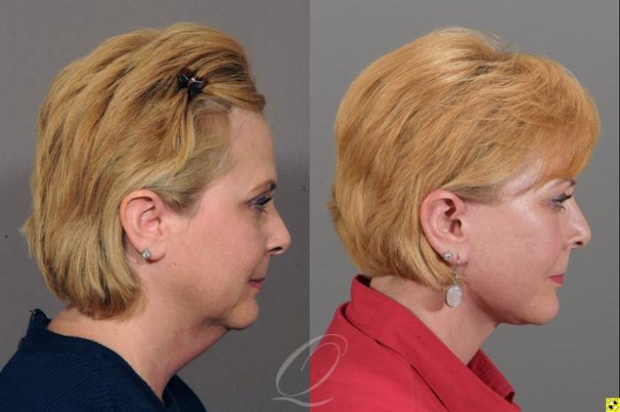 Facelift Case 311 Before & After View #3 | Serving Rochester, Syracuse & Buffalo, NY | Quatela Center for Plastic Surgery