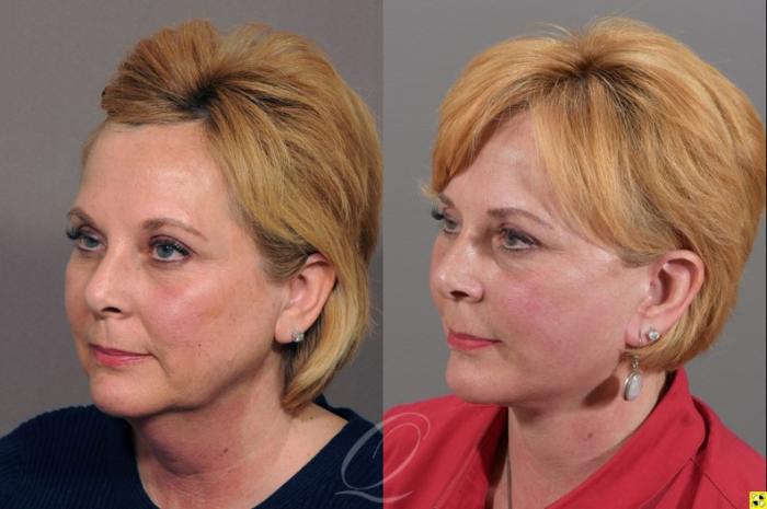 Facelift Case 311 Before & After View #4 | Serving Rochester, Syracuse & Buffalo, NY | Quatela Center for Plastic Surgery