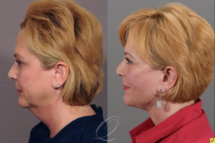 Facelift Case 311 Before & After View #5 | Serving Rochester, Syracuse & Buffalo, NY | Quatela Center for Plastic Surgery