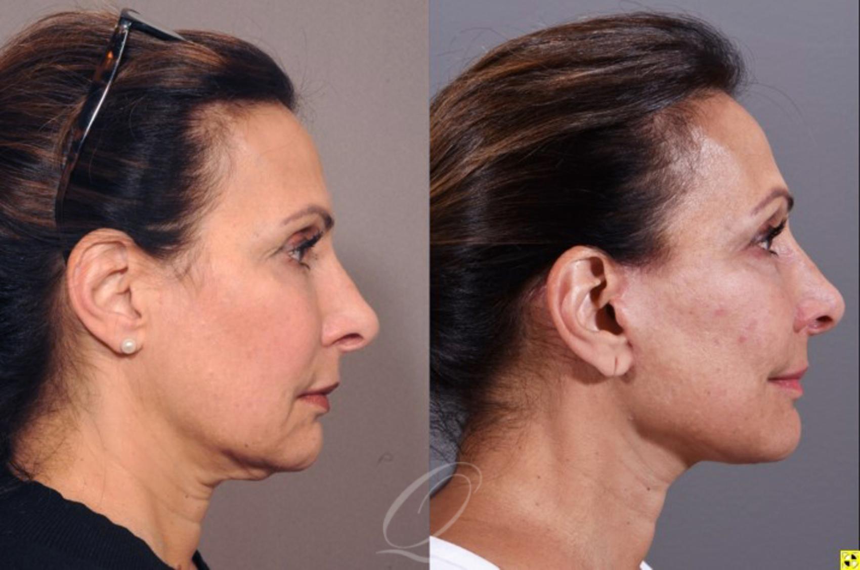 Facelift Case 334 Before & After View #1 | Serving Rochester, Syracuse & Buffalo, NY | Quatela Center for Plastic Surgery