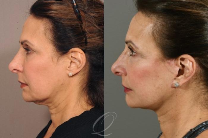 Facelift Case 334 Before & After View #2 | Serving Rochester, Syracuse & Buffalo, NY | Quatela Center for Plastic Surgery