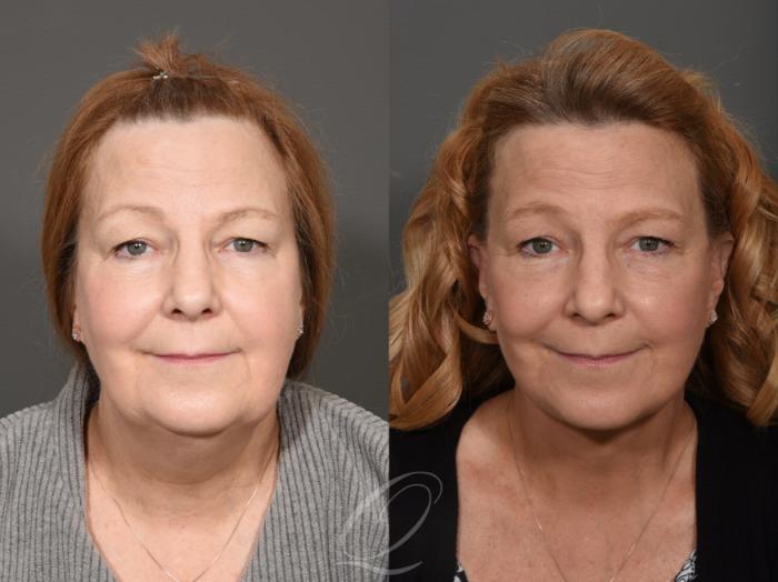 Facelift Case 335 Before & After View #1 | Serving Rochester, Syracuse & Buffalo, NY | Quatela Center for Plastic Surgery