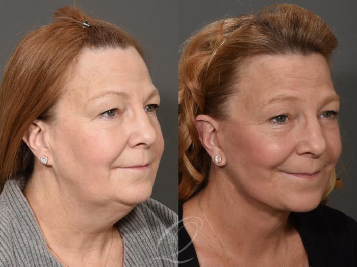 Neck Liposuction Case 335 Before & After View #2 | Serving Rochester, Syracuse & Buffalo, NY | Quatela Center for Plastic Surgery